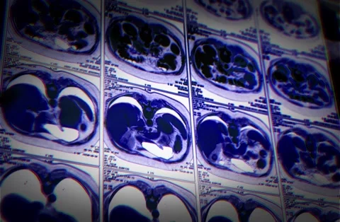 Computed Tomography Ct Scan Of Chest W Stock Video Pond