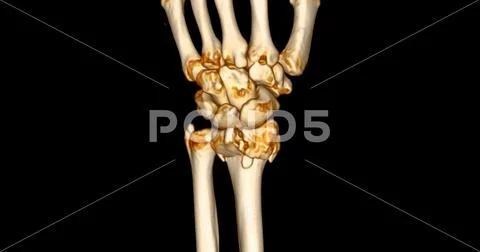 Ct Scan Of Wrist Joint D Rendering For Diagnosis Wrist Joint Pain