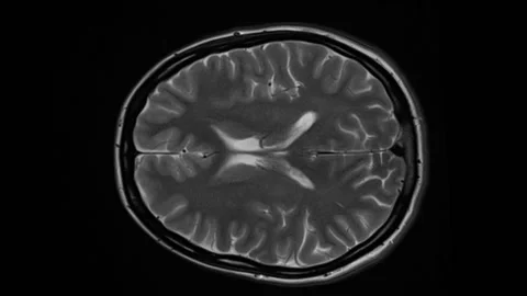 Mri Brain Scan Human Brain Stock Video Pond5