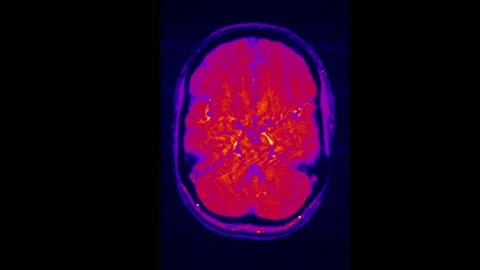 Mri Scan Human Brain Rmn Scan Stock Video Pond