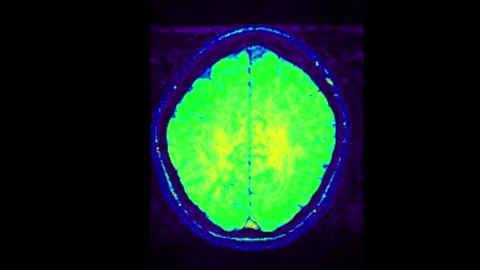 Mri Scan Human Brain RMN Scan Stock Video Pond5