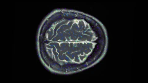 Mri Scan Human Brain Scan Stock Video Pond