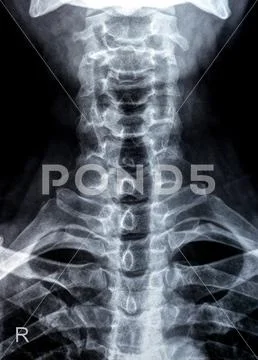 Plain X Ray Of Cervical Spine Revealed Straightened Cervical Curve