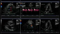 Echocardiogram test captured in six windows