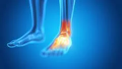 medical animation of a man having acute pain in the foot