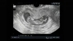 Ultrasound small baby 12 weeks