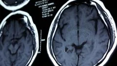 MRI brain scan, Dolly shot