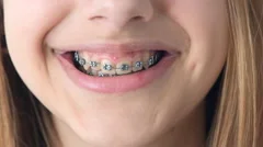 Beautiful smiling girl with braces for teeth .