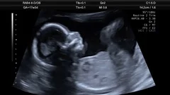 Ultrasound Scan Of 17 Week Old Fetus