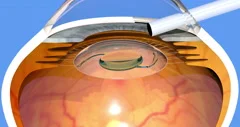 cataract surgery, intraocular lens implantation, 3d render, 4K