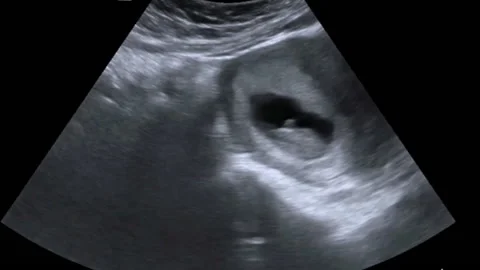10 week old foetus moving in the womb, ultrasound Stock Footage 178665420