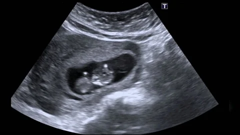 10 week old foetus moving in the womb, u... | Stock Video | Pond5