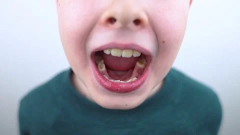 10 year old boy at pediatric dentist showing milk tooth extraction. Concept of c Video stock 335679734