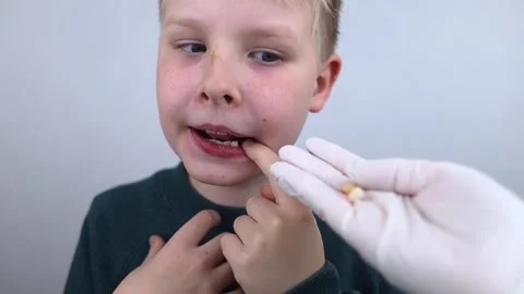 10 year old boy at pediatric dentist showing milk tooth extraction. Concept of c Vídeo Stock 335679744