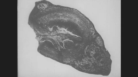 1930s: Cross-Section Of Ruptured Appendix. Arrow Moves Across Appendix. Stock Footage 80736130