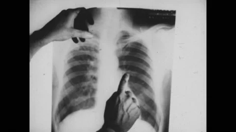 1940s: Animated face talks into a microphone. Hands hold up a chest x-ray. Video stock 165426444