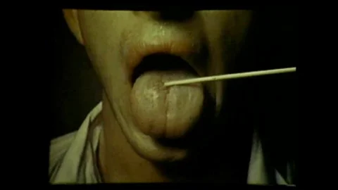 1943 - Chancres, split papules and warts on mens mouths and genitals point Stock Footage 143720153