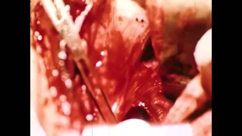 1949 - Surgeons perform an operation on a human heart, which can be seen Stock Footage 246048807
