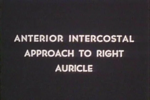 1950 - Drawings are used to render an anterior intercostal approach to right Stock Footage 99793230
