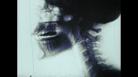 1950s: X-ray of human skull. 스톡 동영상 88788902