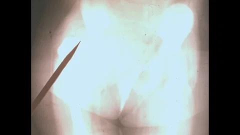1960s: X-ray of pelvis. Stock Footage 295164685