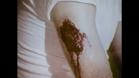 1970s: close up of man with injury to back of arm. Man lies injured man on back. Stock Footage