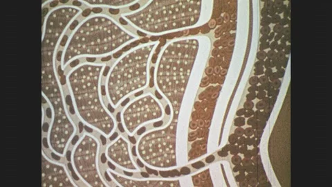 1970s: Red blood cell transforms into sickle-cell. Sickle-cells clog up Stock Footage 87007849