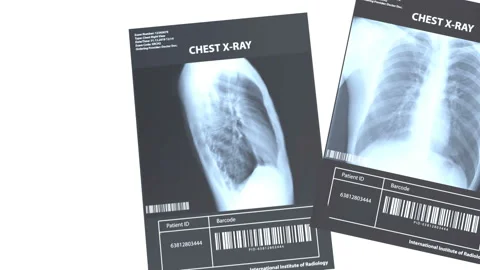 2 x-ray images of the lung and positive analysis Stock Footage 128911239