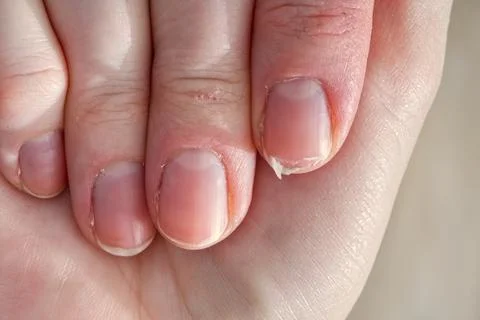 Close-up  of  brittle  nails  on  woman's  hands.  Female  broken  fingernail.  weak  sore  nails. xkwx nail,  broken,  closeup,  finger,  hand,  woman,  weak,  sore,  nails,  health,  care,  skin,  manicure,  treatment,  fingernail,  pain,  medical,  healthy,  hygiene,  medicine,  dry,  clean,  people,  person,  ridges,  body,  background,  peeling,  brittle,  white,  gel-lacquer,  damaged,  unhealthy,  gesturing,  pitted,  fracture,  makeup,  shellac,  break,  accident,  destroy,  fresh,  beauty