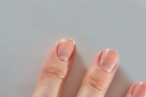 Close-up  of  brittle  nails  on  woman's  hands.  Female  broken  fingernail.  weak  sore  nails. xkwx nail,  broken,  closeup,  finger,  hand,  woman,  weak,  sore,  nails,  health,  care,  skin,  manicure,  treatment,  fingernail,  pain,  medical,  healthy,  hygiene,  medicine,  dry,  clean,  people,  person,  ridges,  body,  background,  peeling,  brittle,  white,  gel-lacquer,  damaged,  unhealthy,  gesturing,  pitted,  fracture,  makeup,  shellac,  break,  accident,  destroy,  fresh,  beauty