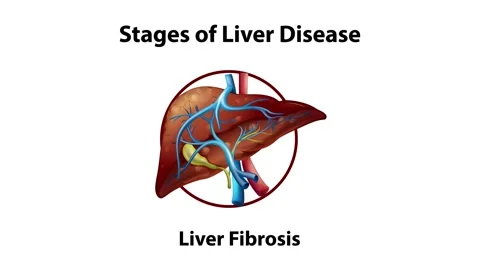 2D animation of stages of liver disease. | Stock Video | Pond5