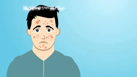 2d flat design in before after face acne animation Stock Footage 130161994