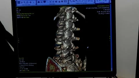 3-D model of the human spine on the monitor screen. Conducting a computed Stock Footage 249073613