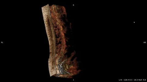 3-D Overview Hernia of a Backbone of Lumbar Department by MRT Method Stock-Footage 71410737