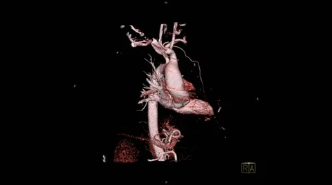 3 d reconstruction of the thoracic and abdominal aorta Stock Footage