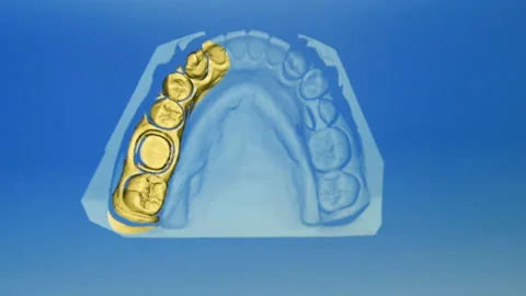 3-d scanning of denture from gypsum Stock-Footage 101441159