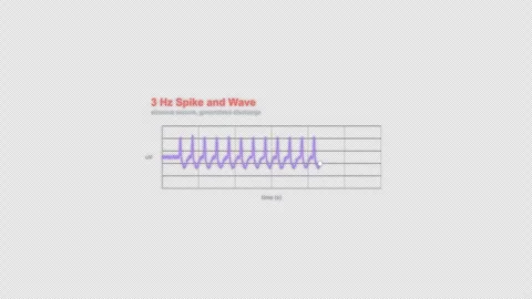 3 Hz Spike and Wave EEG Brain Wave Animation Labeled Video Overlay Alpha 4K Видео 339303736