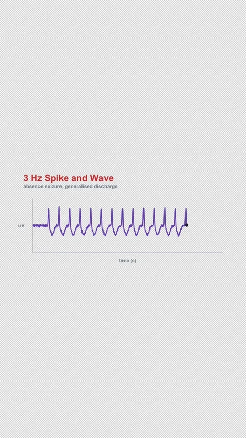 3 Hz Spike and Wave Labeled EEG Brain Wave Alpha 4K Vertical 9x16 Light Vídeos de archivo 339493935