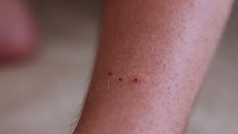 3 ticks creating red marks where they have entered a mans leg Stock Footage 310768091
