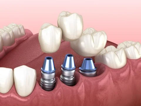 3 tooth crowns placement over 3 implants - concept. 3D illustration of human Stock Illustration