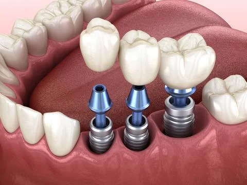 3 tooth crowns placement over 3 implants - concept. 3D illustration of human Illustrazione stock