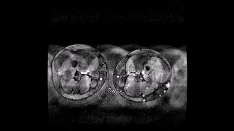 3D Angiogram Video: Advanced Visualization of Vascular Structures Stock Footage 304371399