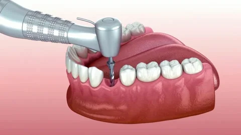 3D Animation: Close-up of Missing Tooth in Lower Jaw Stock Footage 327668591