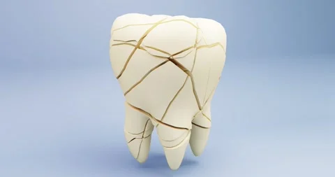3d animation of the composition of the problem of a cracked tooth Stock Footage 307941189