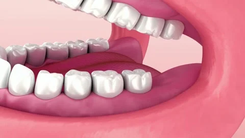 3D Animation of Dental Bridge Installation on Teeth Stock Footage 327668293