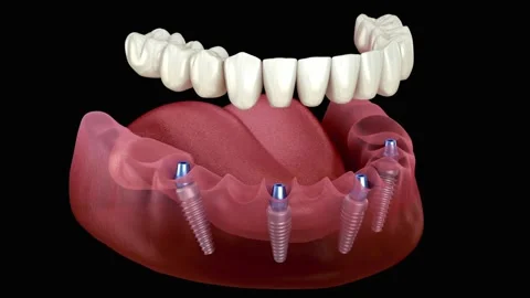 3D Animation of Dental Implants in Jawbone Stock Footage 327667797