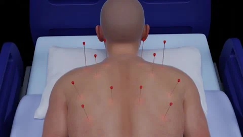 3D Animation of Dry Needling Therapy on Upper Back for Pain Relief. Acupuncture Video stock 315553087