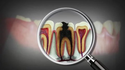 3D animation illustrating a root canal infection Stock Footage 307105326