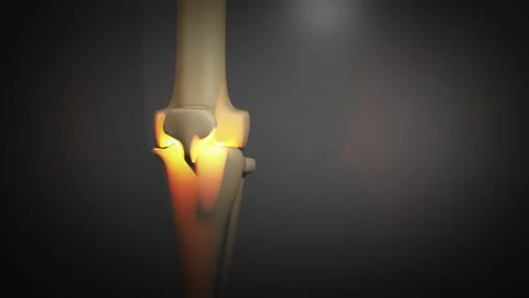 3D Animation of Inflamed Bone-On-Bone Knee Joint Stock Footage 310864295