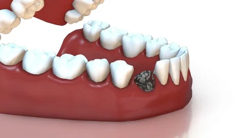 3D animation the installation process of dental implants. Stock Footage 77325175